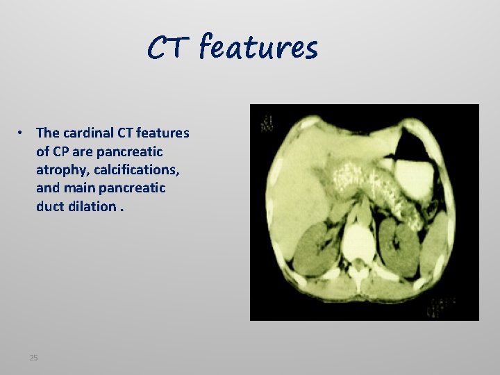 CT features • The cardinal CT features of CP are pancreatic atrophy, calcifications, and