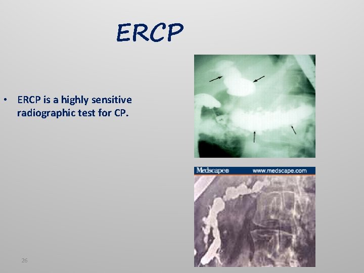 ERCP • ERCP is a highly sensitive radiographic test for CP. 26 