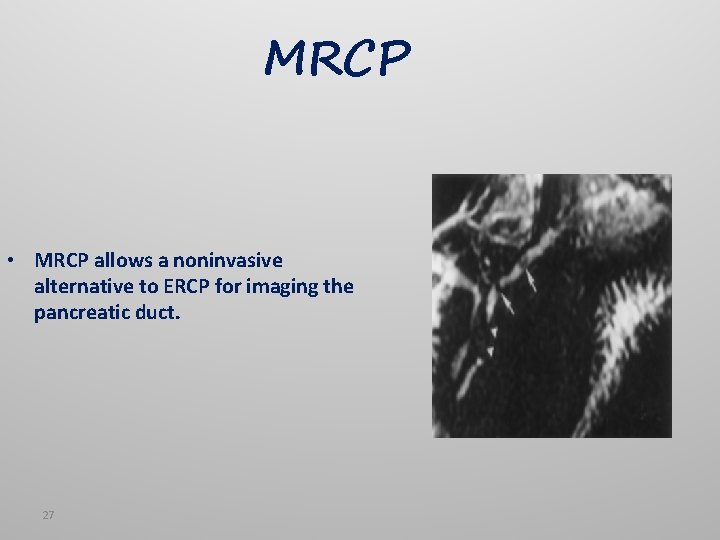 MRCP • MRCP allows a noninvasive alternative to ERCP for imaging the pancreatic duct.