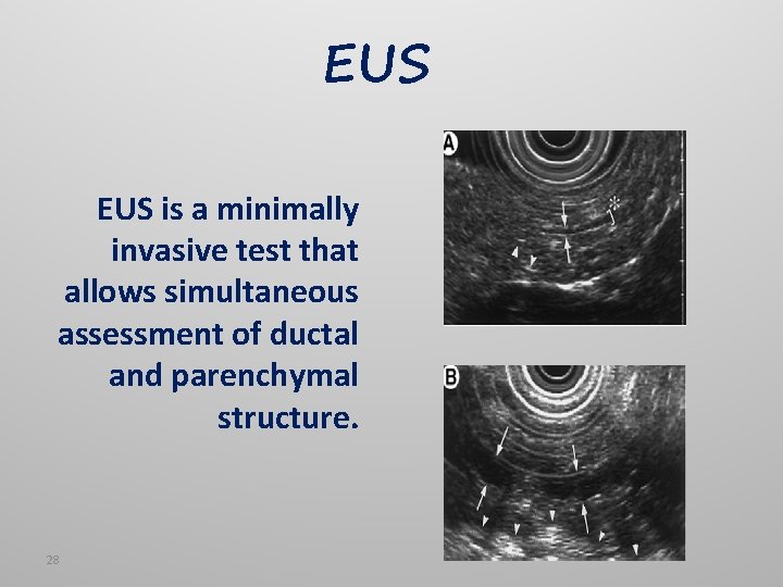 EUS is a minimally invasive test that allows simultaneous assessment of ductal and parenchymal