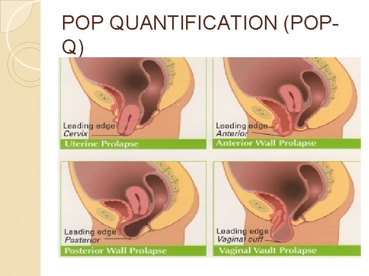 POP QUANTIFICATION (POPQ) 