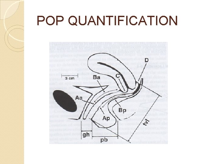 POP QUANTIFICATION 