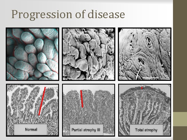 Progression of disease 