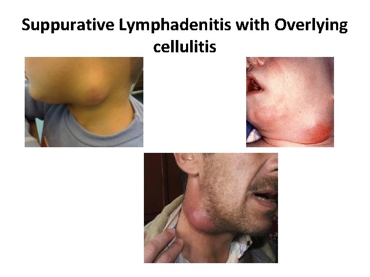 Suppurative Lymphadenitis with Overlying cellulitis 