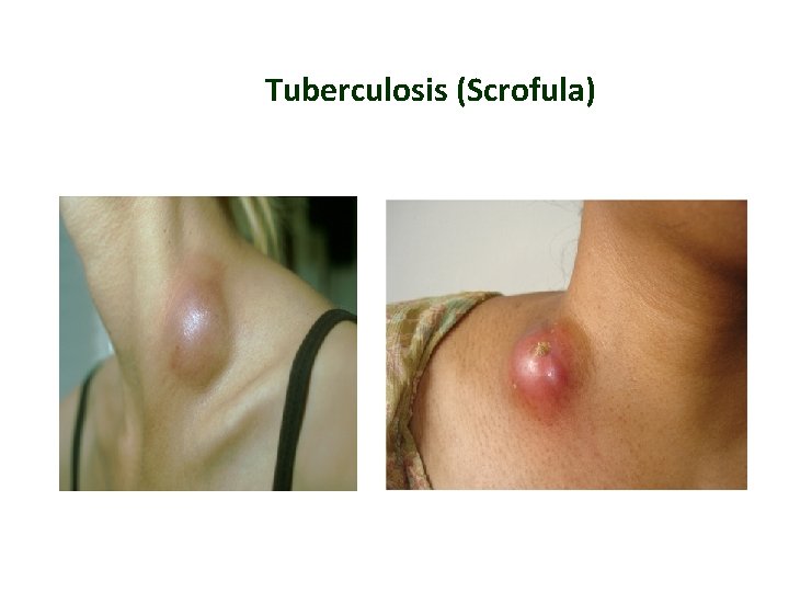 Tuberculosis (Scrofula) 