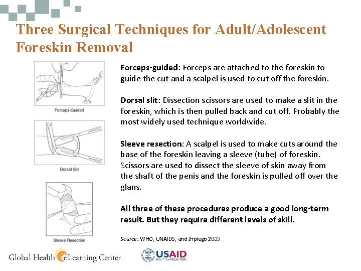 Three Surgical Techniques for Adult/Adolescent Foreskin Removal Forceps-guided: Forceps are attached to the foreskin