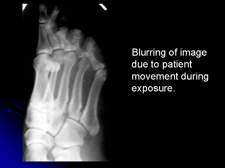 Blurring of image due to patient movement during exposure. 