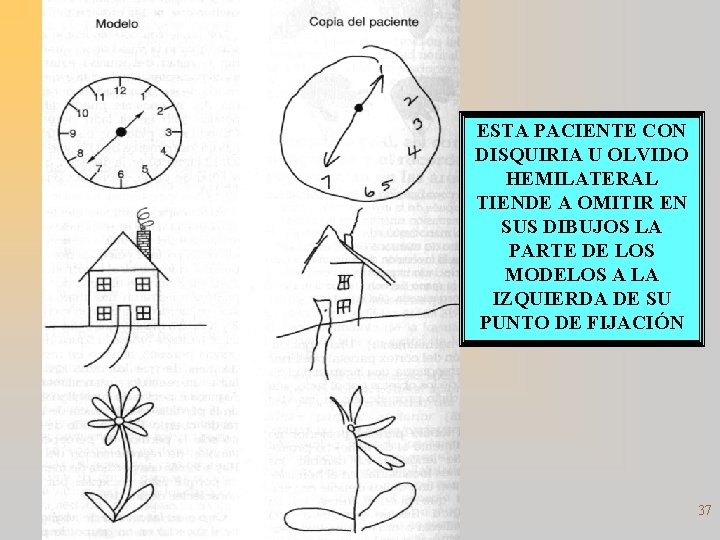 ESTA PACIENTE CON DISQUIRIA U OLVIDO HEMILATERAL TIENDE A OMITIR EN SUS DIBUJOS LA