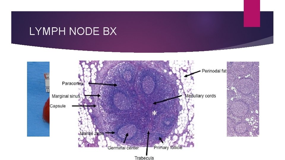 LYMPH NODE BX 