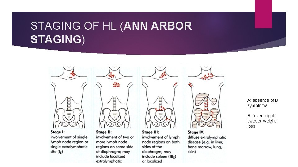 STAGING OF HL (ANN ARBOR STAGING) A: absence of B symptoms B: fever, night