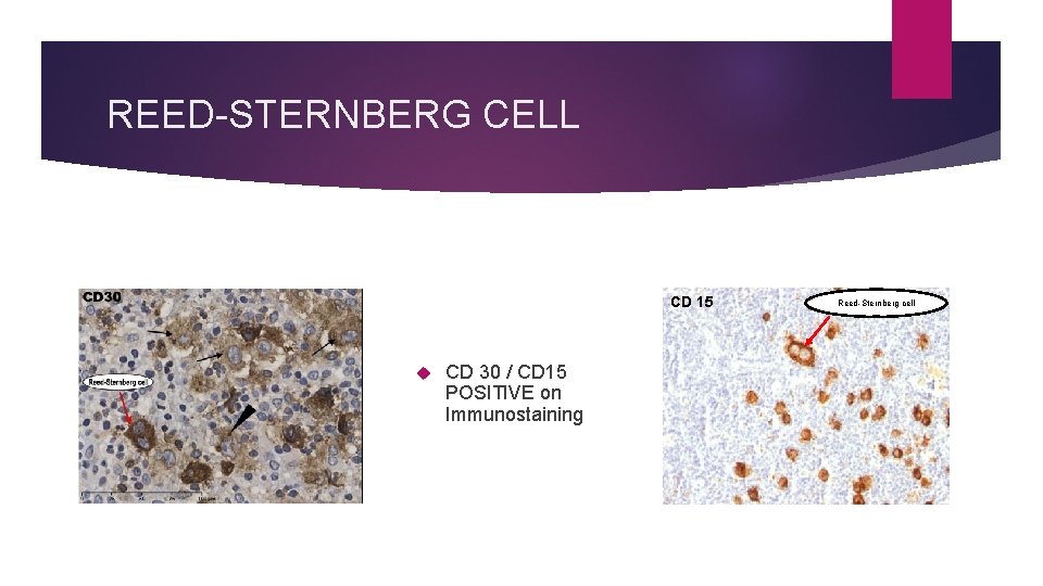 REED-STERNBERG CELL CD 15 CD 30 / CD 15 POSITIVE on Immunostaining Reed-Sternberg cell