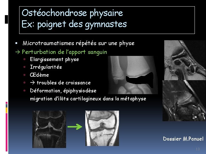 Ostéochondrose physaire Ex: poignet des gymnastes Microtraumatismes répétés sur une physe Perturbation de l’apport