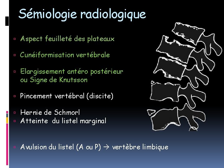 Sémiologie radiologique Aspect feuilleté des plateaux Cunéiformisation vertébrale Elargissement antéro postérieur ou Signe de