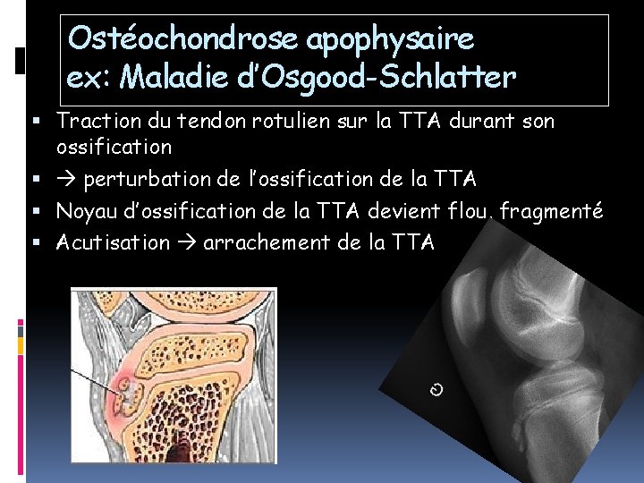 Ostéochondrose apophysaire ex: Maladie d’Osgood-Schlatter Traction du tendon rotulien sur la TTA durant son