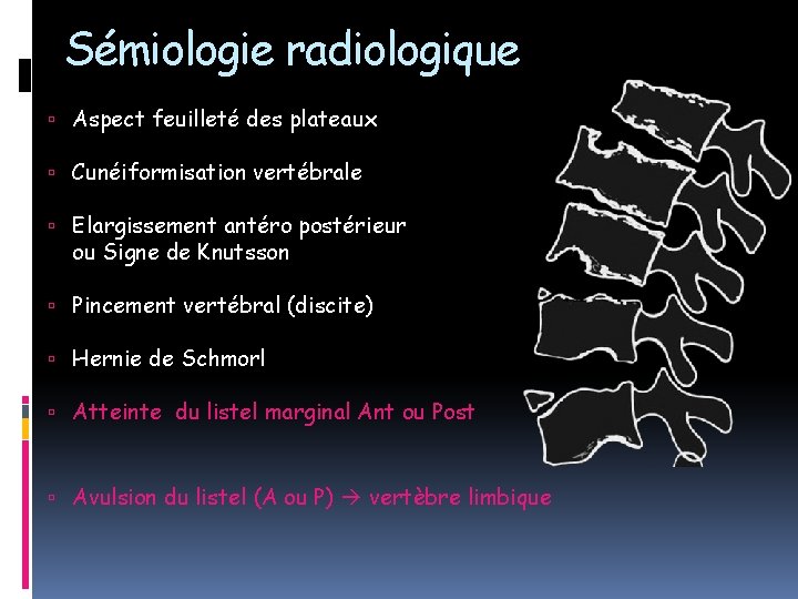 Sémiologie radiologique Aspect feuilleté des plateaux Cunéiformisation vertébrale Elargissement antéro postérieur ou Signe de