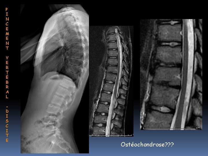 P I N C E M E N T V E R T É