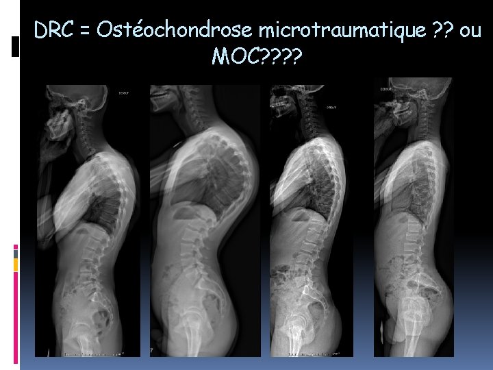 DRC = Ostéochondrose microtraumatique ? ? ou MOC? ? 