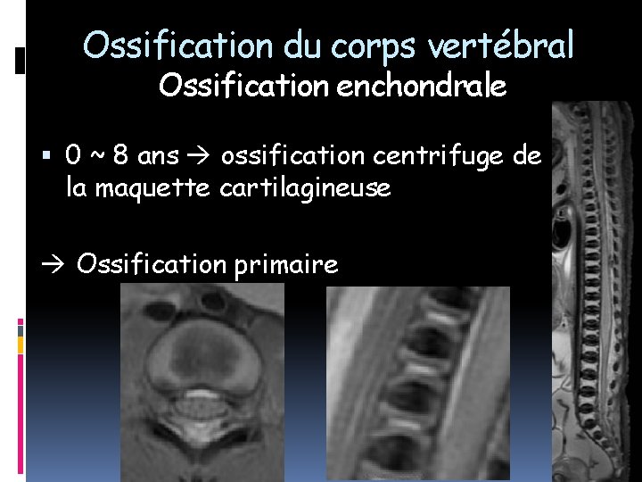 Ossification du corps vertébral Ossification enchondrale 0 ~ 8 ans ossification centrifuge de la