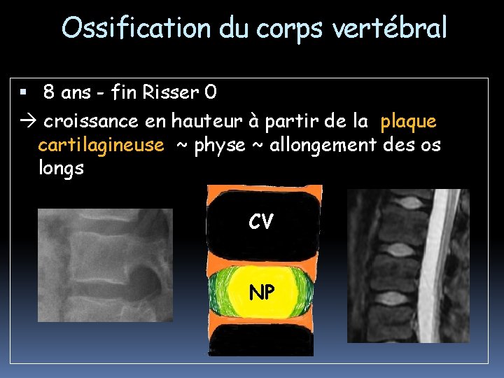 Ossification du corps vertébral 8 ans - fin Risser 0 croissance en hauteur à