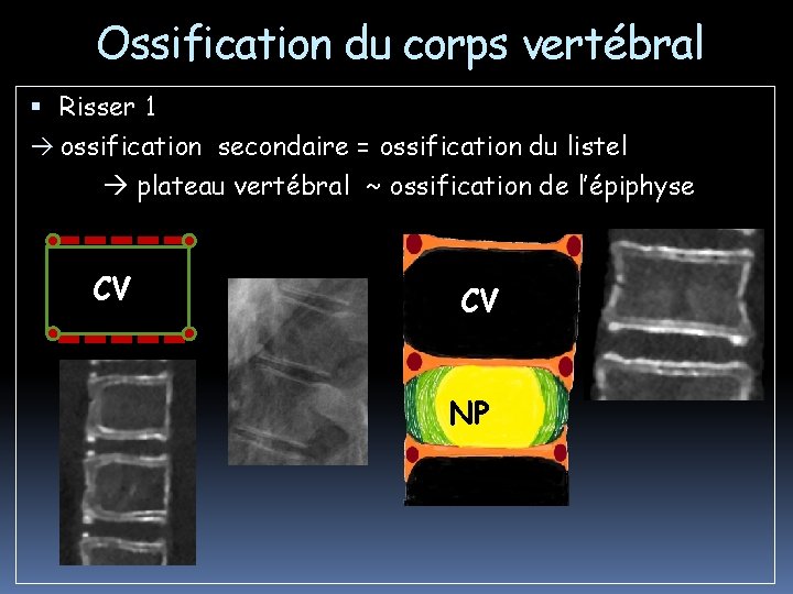 Ossification du corps vertébral Risser 1 ossification secondaire = ossification du listel plateau vertébral