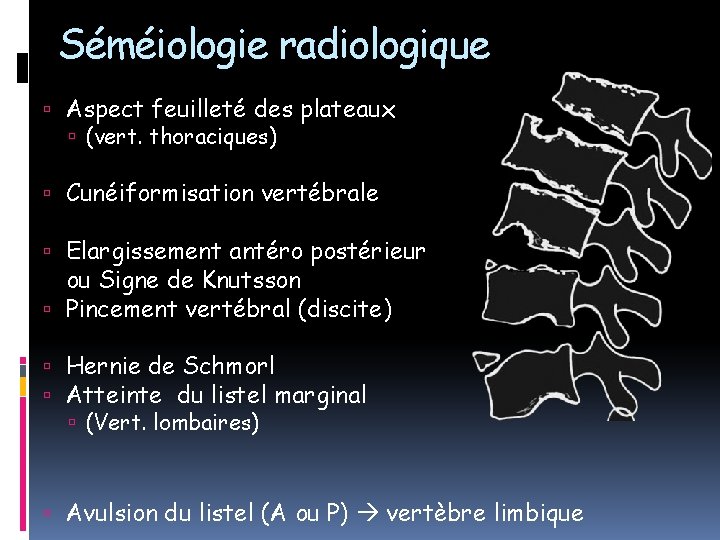 Séméiologie radiologique Aspect feuilleté des plateaux (vert. thoraciques) Cunéiformisation vertébrale Elargissement antéro postérieur ou