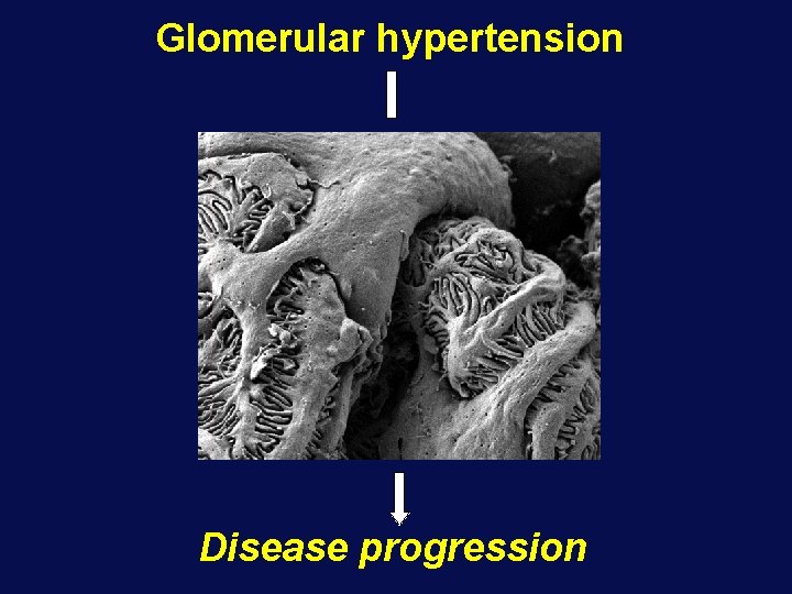 Glomerular hypertension Disease progression 