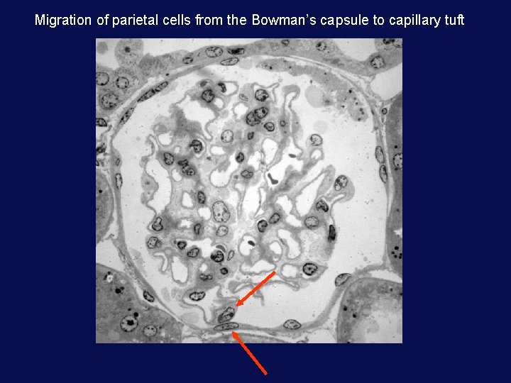 Migration of parietal cells from the Bowman’s capsule to capillary tuft 