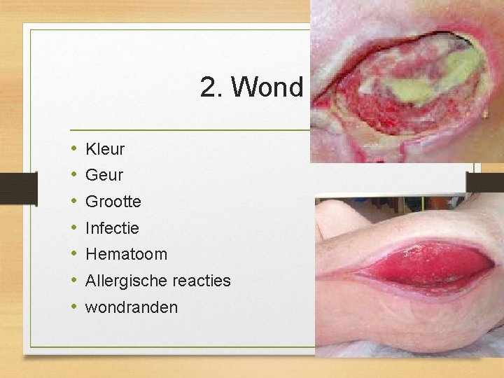 2. Wond • • Kleur Grootte Infectie Hematoom Allergische reacties wondranden 2. Wond • • Kleur Grootte Infectie Hematoom Allergische reacties wondranden