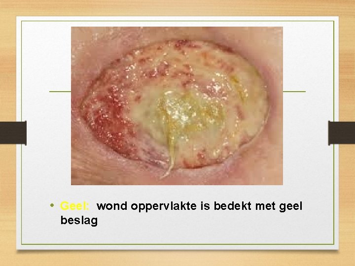 • Geel: wond oppervlakte is bedekt met geel beslag • Geel: wond oppervlakte is bedekt met geel beslag