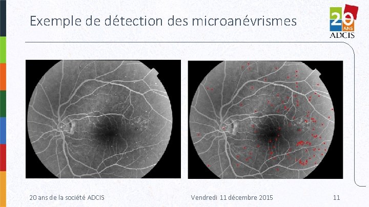 Exemple de détection des microanévrismes 20 ans de la société ADCIS Vendredi 11 décembre