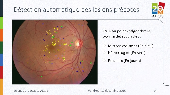 Détection automatique des lésions précoces Mise au point d’algorithmes pour la détection des :