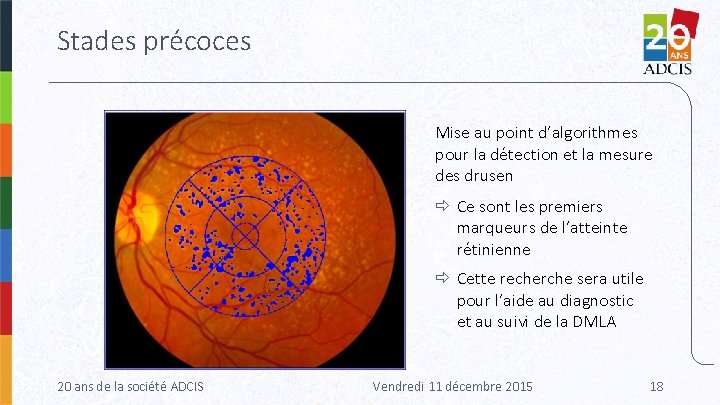 Stades précoces Mise au point d’algorithmes pour la détection et la mesure des drusen