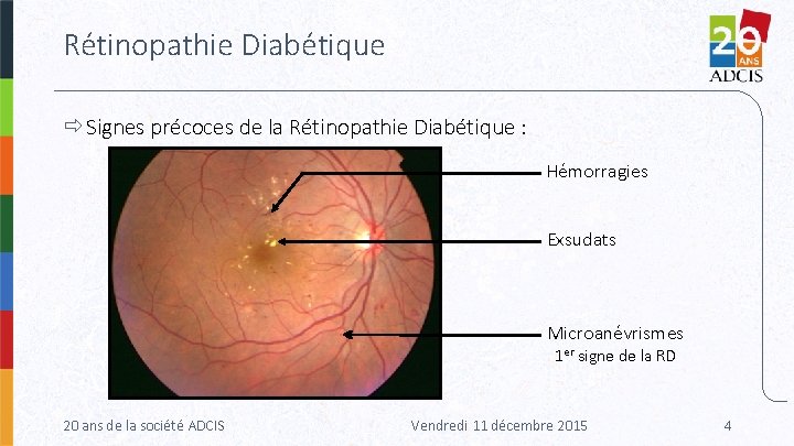 Rétinopathie Diabétique Signes précoces de la Rétinopathie Diabétique : Hémorragies Exsudats Microanévrismes 1 er