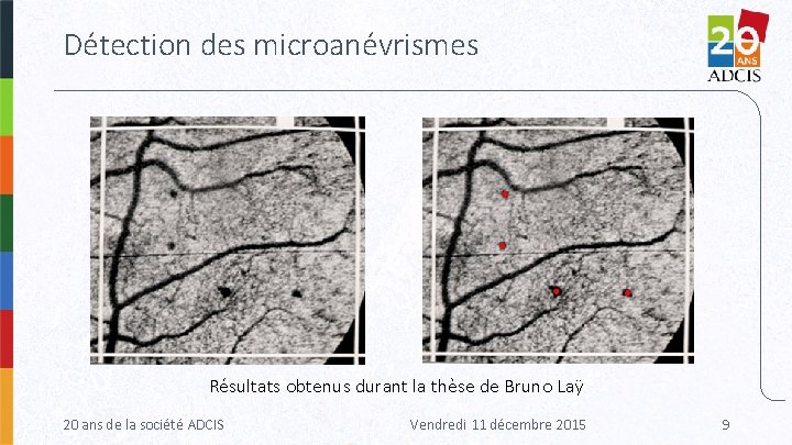 Détection des microanévrismes Résultats obtenus durant la thèse de Bruno Laÿ 20 ans de