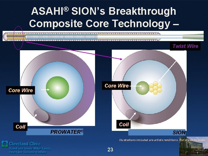 ASAHI® SION’s Breakthrough Composite Core Technology – Distal Portion Twist Wire Core Wire Coil