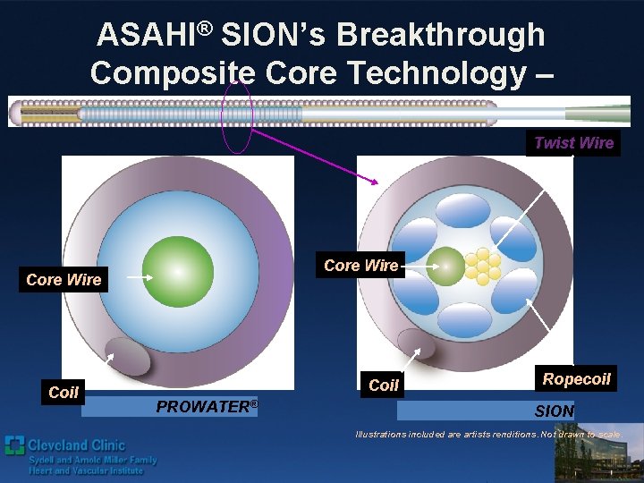 ASAHI® SION’s Breakthrough Composite Core Technology – Proximal Portion Twist Wire Core Wire Coil