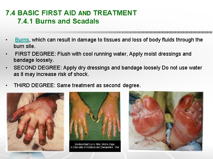 7. 4 BASIC FIRST AID AND TREATMENT 7. 4. 1 Burns and Scadals •