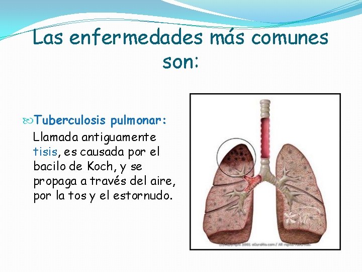 Las enfermedades más comunes son: Tuberculosis pulmonar: Llamada antiguamente tisis, es causada por el Las enfermedades más comunes son: Tuberculosis pulmonar: Llamada antiguamente tisis, es causada por el