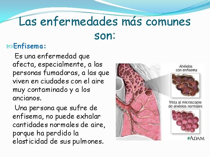 Las enfermedades más comunes son: Enfisema: Es una enfermedad que afecta, especialmente, a las Las enfermedades más comunes son: Enfisema: Es una enfermedad que afecta, especialmente, a las