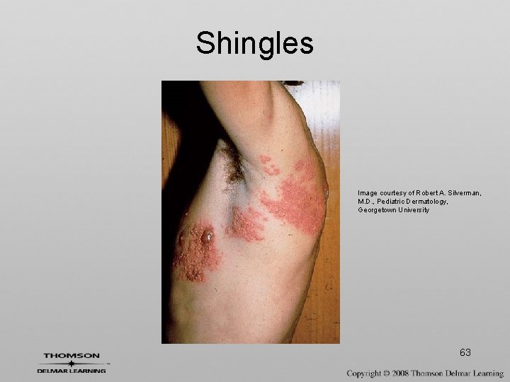 Shingles Image courtesy of Robert A. Silverman, M. D. , Pediatric Dermatology, Georgetown University