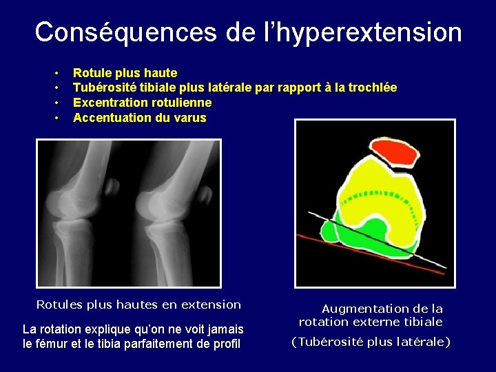 Conséquences de l’hyperextension • • Rotule plus haute Tubérosité tibiale plus latérale par rapport