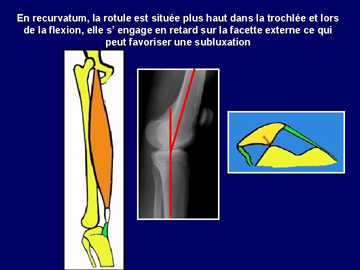 En recurvatum, la rotule est située plus haut dans la trochlée et lors de