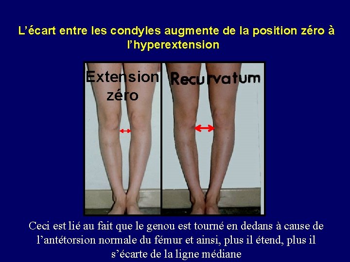  L’écart entre les condyles augmente de la position zéro à l’hyperextension Extension zéro