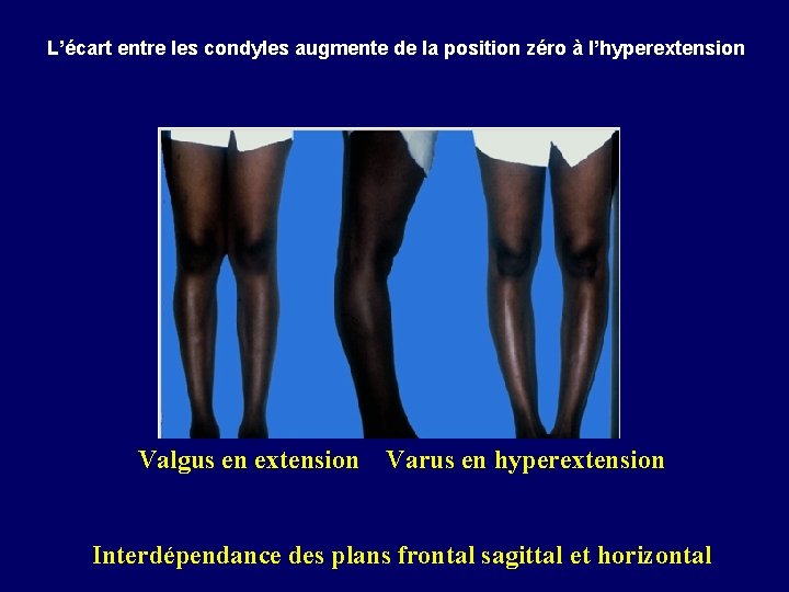  L’écart entre les condyles augmente de la position zéro à l’hyperextension Valgus en