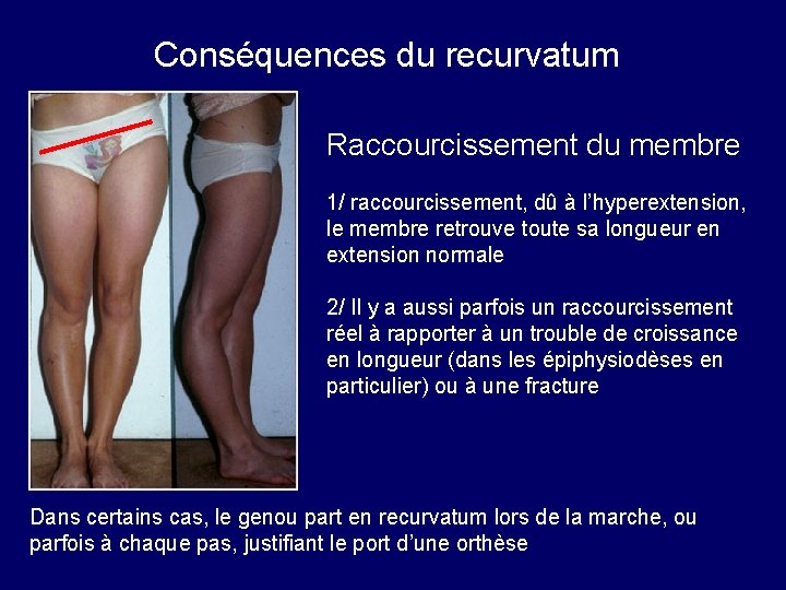 Conséquences du recurvatum Raccourcissement du membre 1/ raccourcissement, dû à l’hyperextension, le membre retrouve