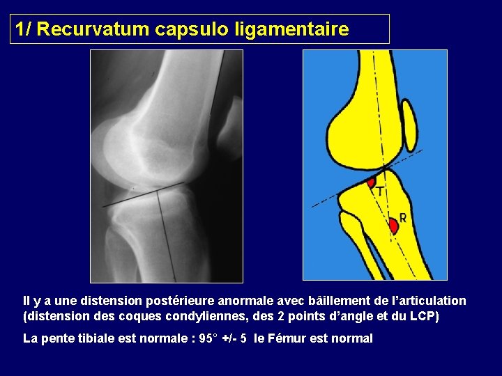 1/ Recurvatum capsulo ligamentaire Il y a une distension postérieure anormale avec bâillement de