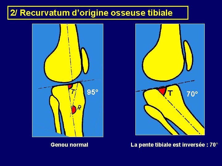 2/ Recurvatum d’origine osseuse tibiale 95° 70° Genou normal La pente tibiale est inversée