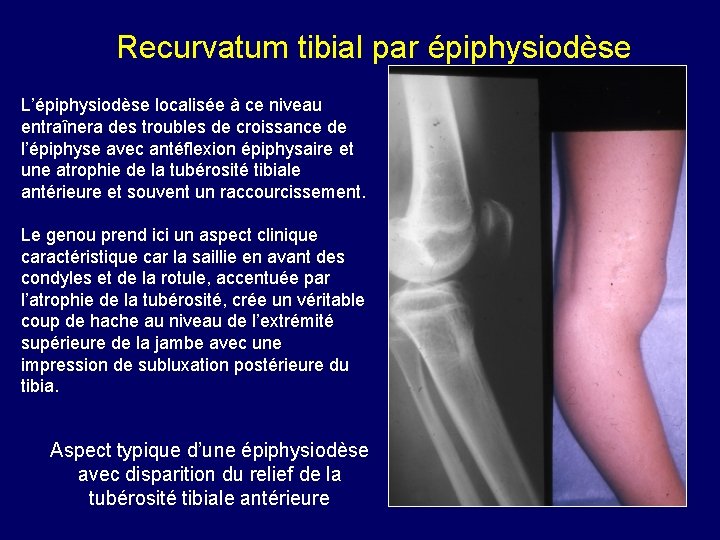 Recurvatum tibial par épiphysiodèse L’épiphysiodèse localisée à ce niveau entraînera des troubles de croissance