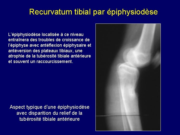 Recurvatum tibial par épiphysiodèse L’épiphysiodèse localisée à ce niveau entraînera des troubles de croissance