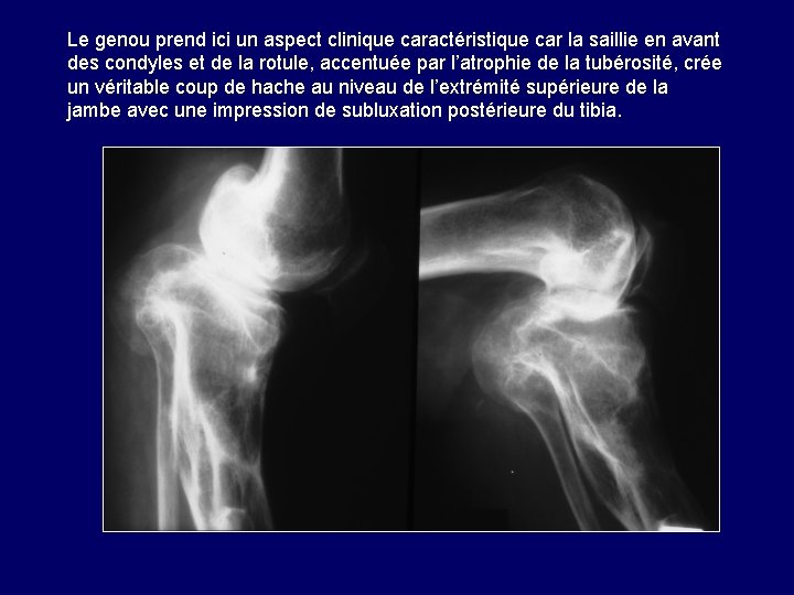 Le genou prend ici un aspect clinique caractéristique car la saillie en avant des Le genou prend ici un aspect clinique caractéristique car la saillie en avant des